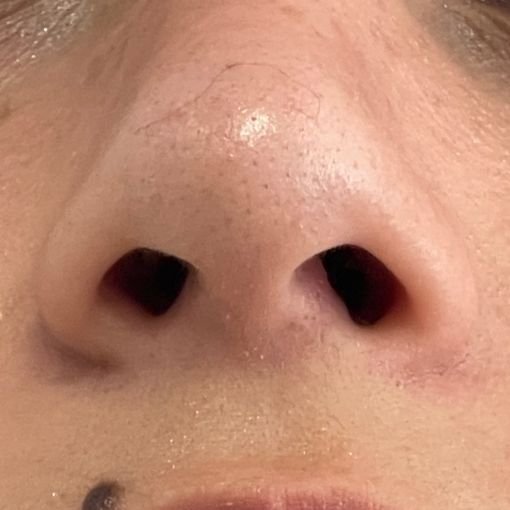 rinoplastias punta nasal resultado 4