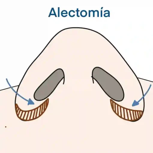 alectomia