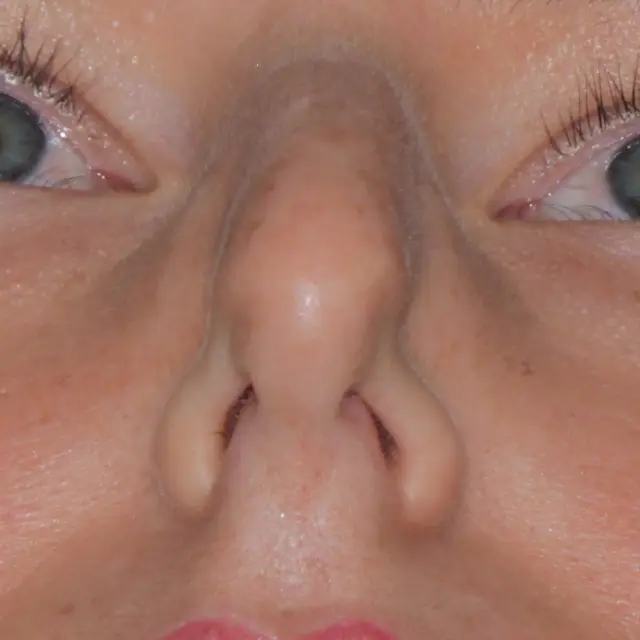 colapso valvular nasal